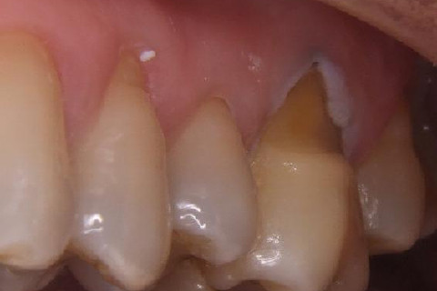 Preparo do dente. Regularização do esmalte cervical eliminando áreas retentivas. Jateamento com óxido de alumínio e hibridização...