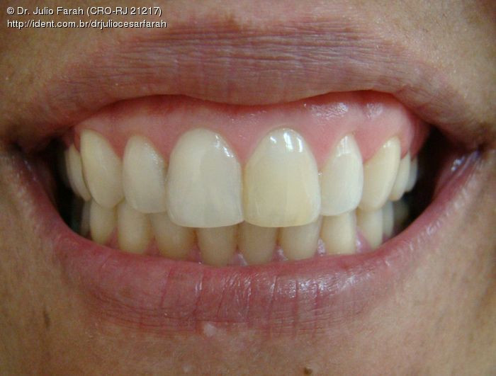 Clareamento Interno Para Dentes Desvitalizados Caso Cl nico IDent clareamento-interno-para-dentes-desvitalizados-caso-cl-nico-ident