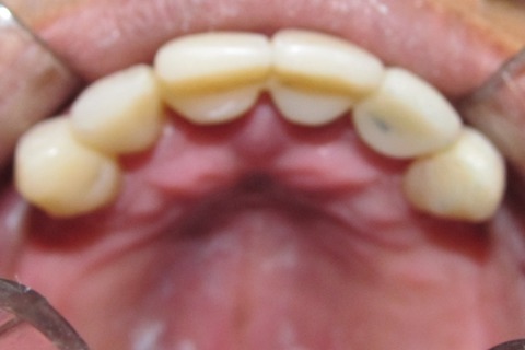 Aspecto da palatina dos superiores com maior espessura na região palatina e vestibular com a finalidade de servir de contenção oclusal (palatina) e de reforço por aumento de espessura (vestibular). Aspecto da palatina dos superiores com maior espessura na região palatina e vestibular com a finalidade de servir de contenção oclusal (palatina) e de reforço por aumento de espessura (vestibular).