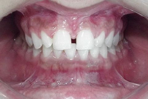 Caso Inicial. Diastema generoso. Paciente não quer nem pensar em ortodontia. Caso Inicial. Diastema generoso. Paciente não quer nem pensar em ortodontia.