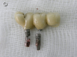 Remoção de Implante