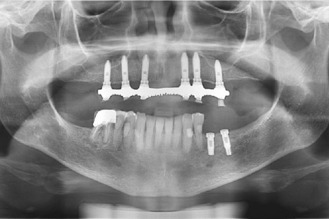 Panorâmica final com os implantes já instalados. Panorâmica final com os implantes já instalados.