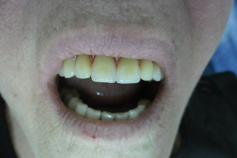 Prova dos dentes em cera. Prova dos dentes em cera.