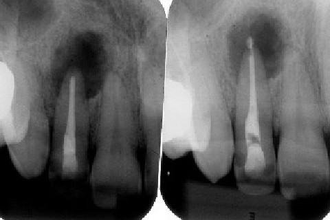 Murillo Sacon - Sacon Endodontia Murillo Sacon - Sacon Endodontia