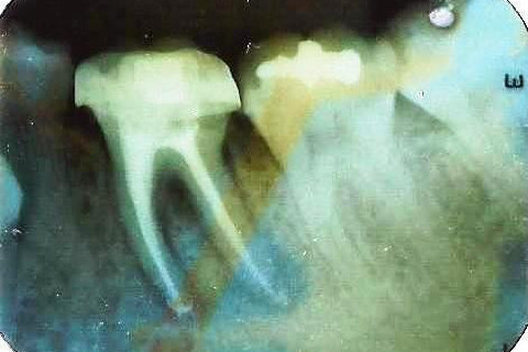 Radiografia final - Murillo Sacon - Sacon endodontia Radiografia final - Murillo Sacon - Sacon endodontia