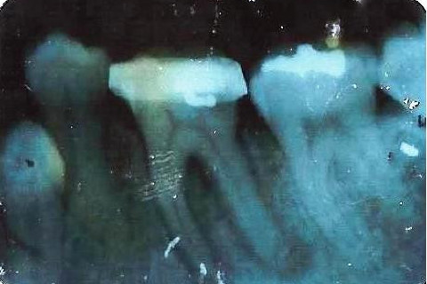 Radiografia inicial - Murillo Sacon - Sacon endodontia Radiografia inicial - Murillo Sacon - Sacon endodontia