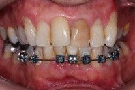 Caso Clínico: Alterações de Forma, Posição e Coloração de Dentes Anteriores
