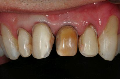 Caso Clínico: Alterações de Forma, Posição e Coloração de Dentes Anteriores