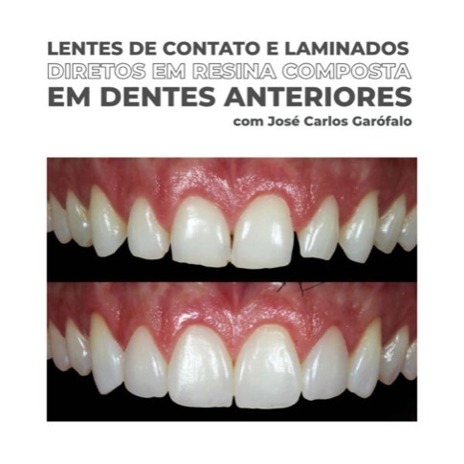 Lentes de Contato e Laminados Diretos em Resina Composta em Dentes Anteriores
