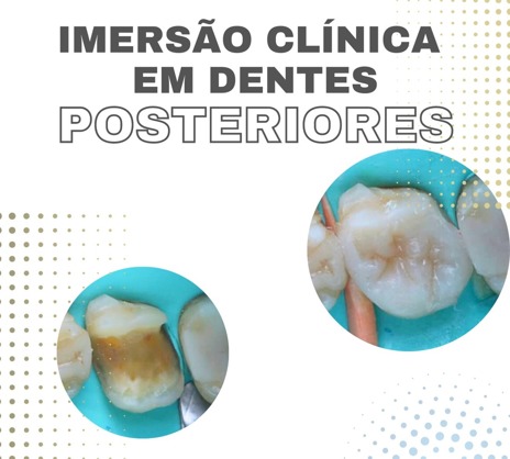 Imersão Clínica em Dentes Posteriores