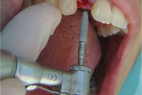Implante Alvim CM 3.5 por 13mm