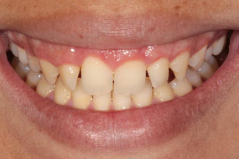 SORRISO INICIAL