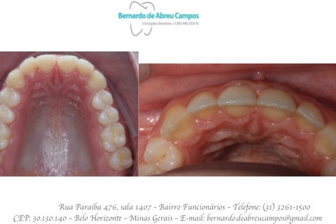 Vista Oclusal. Fechamento dos diastemas com uso de 3 placas (45 dias) Vista Oclusal. Fechamento dos diastemas com uso de 3 placas (45 dias)