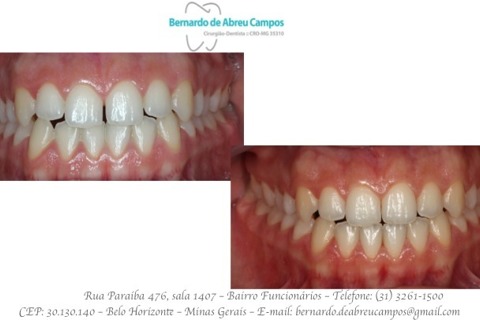 Vista Frontal. Fechamento dos diastemas com uso de 3 placas (45 dias) Vista Frontal. Fechamento dos diastemas com uso de 3 placas (45 dias)