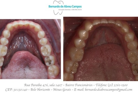 Vista Oclusal da arcada inferior. Alinhamento em 60 dias. Vista Oclusal da arcada inferior. Alinhamento em 60 dias.