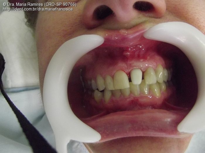 Prótese Fixa (Dente 21), Confecção de Núcleo, Coping de Zirconia e ...