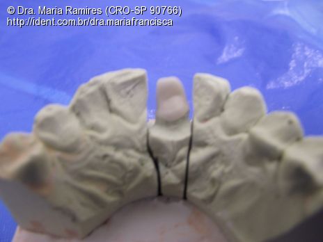 Prótese Fixa (Dente 21), Confecção de Núcleo, Coping de Zirconia e ...