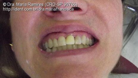 Prótese Fixa (Dente 21), Confecção de Núcleo, Coping de Zirconia e ...