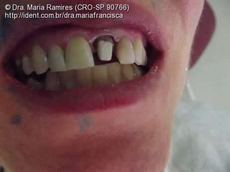 Prótese Fixa (Dente 21), Confecção de Núcleo, Coping de Zirconia e ...