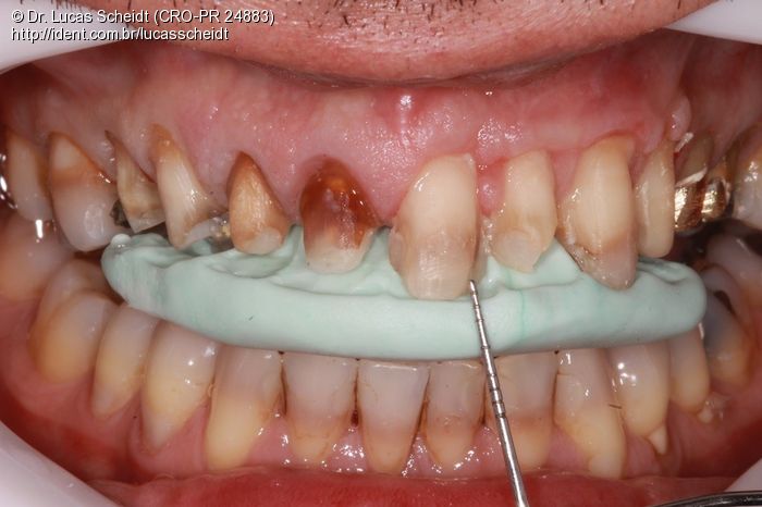 Reabilitação Estética Anterior em Dentes com Manchamento por ...