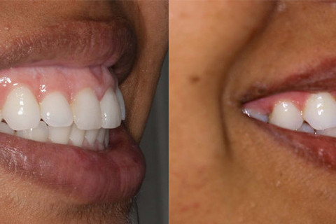 Antes e Depois 1 Antes e Depois 1