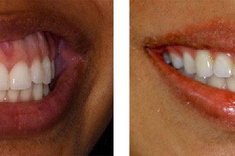 Antes e Depois 2 Antes e Depois 2