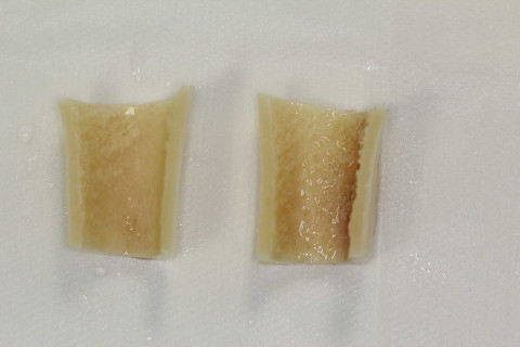 anel de tibia de doador humano