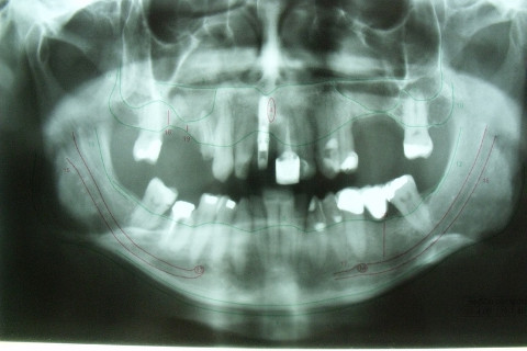 Radiografia panorâmica do caso