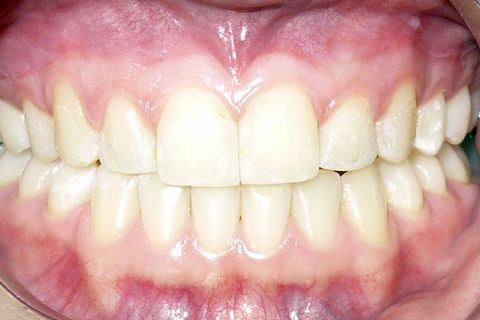 Oclusal Final
