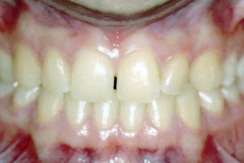 Oclusal Inicial