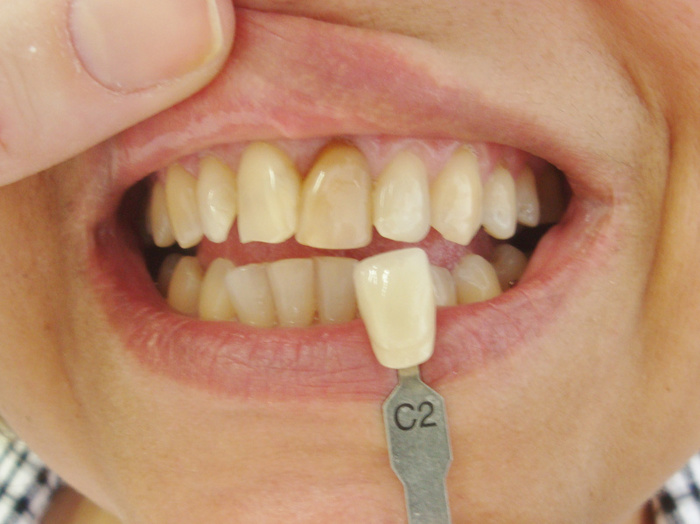 Clareamento De Dente Desvitalizado Caso Cl nico IDent clareamento-de-dente-desvitalizado-caso-cl-nico-ident