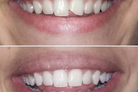 Antes e depois. Antes e depois.