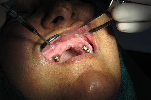 área enxertada após 06 meses de cirurgia