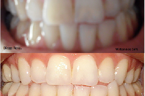 Antes e Depois. Antes e Depois.