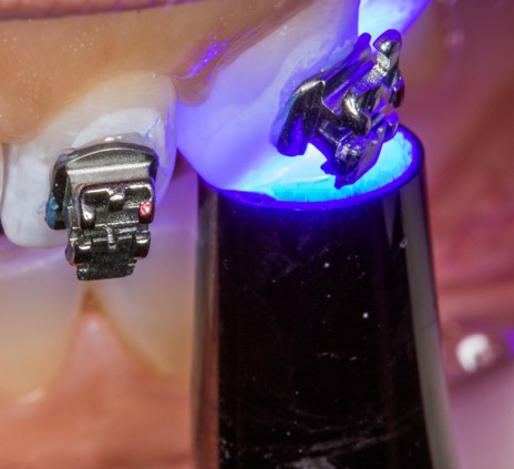 4a - Uma vez devidamente posicionados e já sem excessos de cimento, os bráquetes são fotopolimerizados individualmente por 10s em cada margem (40s total por peça). A figura 4c mostra os bráquetes já instalados.