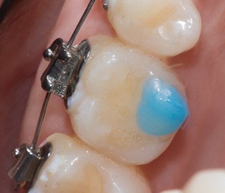 5a - Neste caso, os bráquetes foram instalados em ambos os arcos na mesma sessão. Por isso, o levante de mordida foi realizado imediatamente após a colagem, com pequenos incrementos de ORTHOBITE (FGM) nos molares superiores.