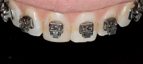 4c Uma vez devidamente posicionados e já sem excessos de cimento, os bráquetes são fotopolimerizados individualmente por 10s em cada margem (40s total por peça). A figura 4c mostra os bráquetes já instalados.