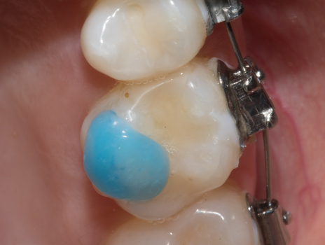 5b - Neste caso, os bráquetes foram instalados em ambos os arcos na mesma sessão. Por isso, o levante de mordida foi realizado imediatamente após a colagem, com pequenos incrementos de ORTHOBITE (FGM) nos molares superiores.