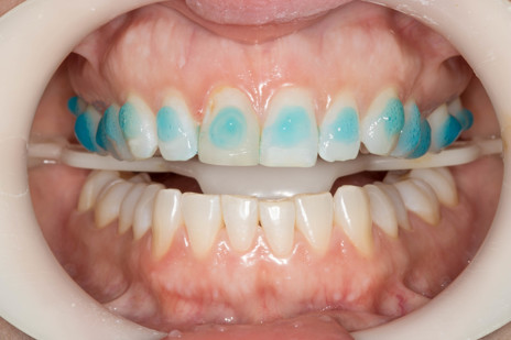 2a - Condicionamento ácido (Condac 37, FGM) por 30s na face vestibular dos dentes que receberão os bráquetes simultaneamente