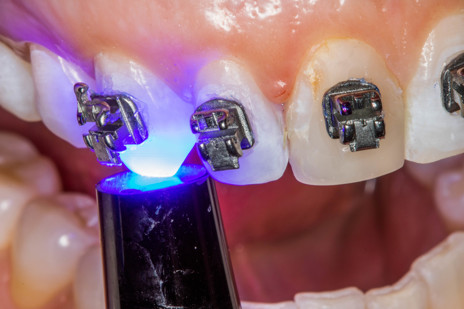 4b - Uma vez devidamente posicionados e já sem excessos de cimento, os bráquetes são fotopolimerizados individualmente por 10s em cada margem (40s total por peça). A figura 4c mostra os bráquetes já instalados.