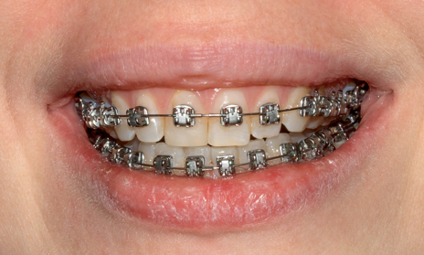 6 - Aspecto final do caso após a colagem.