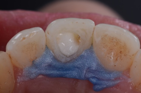 Ao concluir a sessão, a aplicação de outro gel clareador (Whiteness Perborato) como curativo de demora complementa a ação clareadora nos intervalos entre sessões e potencializa o resultado.