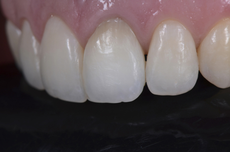 O resultado final foi satisfatório, integrando o dente ao sorriso.