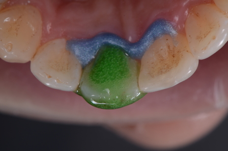 O gel clareador Whiteness HP Maxx pode ser aplicado externamente e internamente na coroa dental, desde que se faça previamente a barreira cervical.