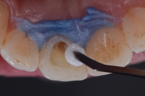Ao concluir a sessão, a aplicação de outro gel clareador (Whiteness Perborato) como curativo de demora complementa a ação clareadora nos intervalos entre sessões e potencializa o resultado.