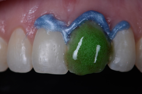 O gel clareador Whiteness HP Maxx pode ser aplicado externamente e internamente na coroa dental, desde que se faça previamente a barreira cervical.