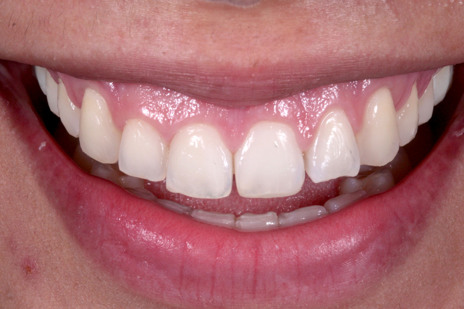 Harmonização dos Dentes Anteriores com Facetas Diretas