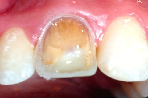 Dente pronto para receber as camadas de Dentina e Esmalte