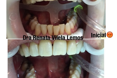 Clareamento Dental a laser com Whiteness HP Maxx