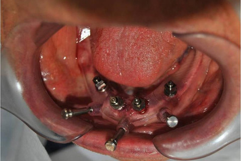 Implantes instalados.